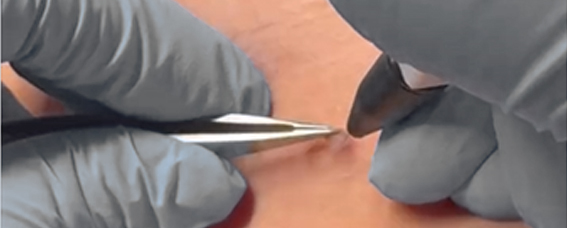 Advanced Electrolysis